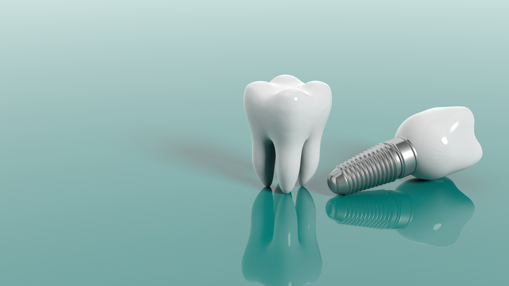 Dental Implants Treatment