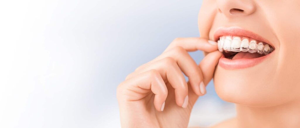 dental invisalign in Agoura Hills