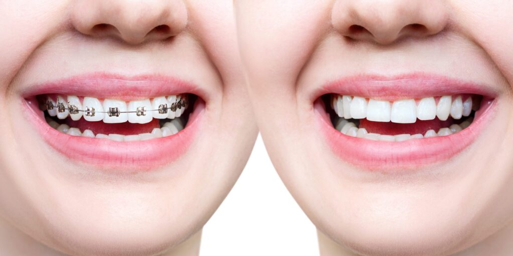 invisalign treatment