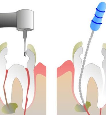 Root Canal Service