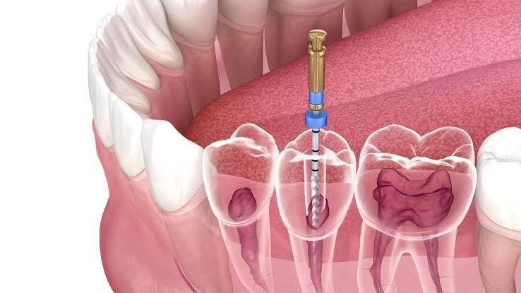Root canal in Agoura Hills