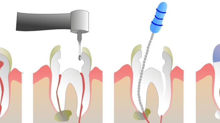 Root Canal Service