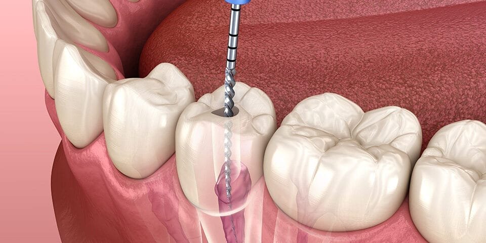 root-canal
